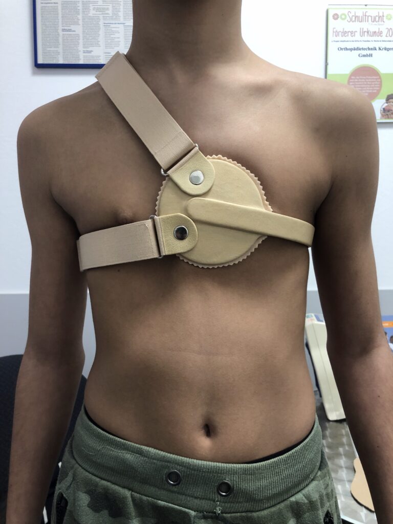 Kind mit einer Brustorthese aus Leder und Metallgelenken, die quer über den Brustkorb verläuft.
