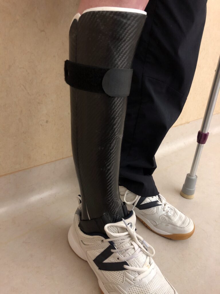 Bein mit angelegter Unterschenkelorthese aus Carbon, fixiert mit einem Klettverschlussriemen. Getragen in Sportschuhen, daneben eine Gehhilfe.